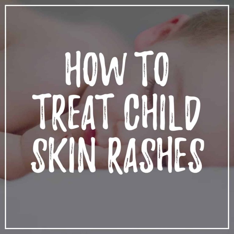 How To Treat Children’s Skin Rashes