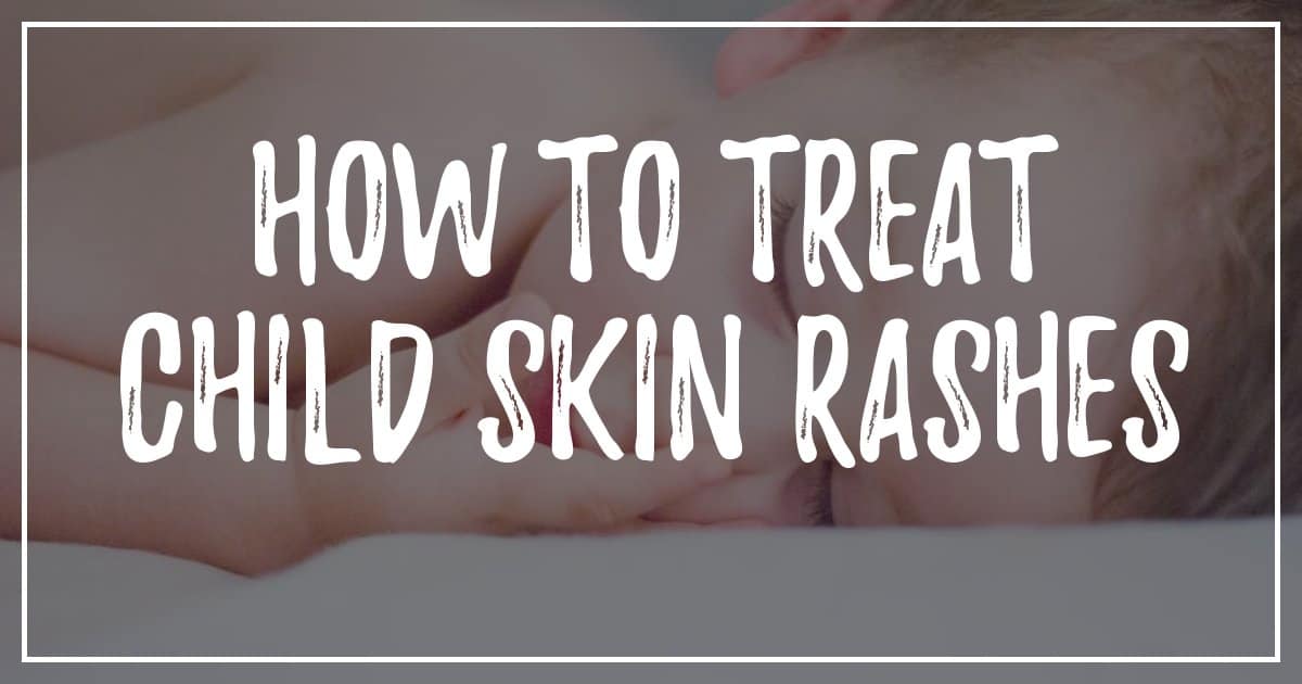 How To Treat Children's Skin Rashes